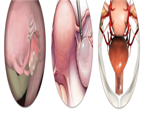 试管包成功价格,弓形子宫凹陷6mm能否顺产?生殖专家给出了具体答案